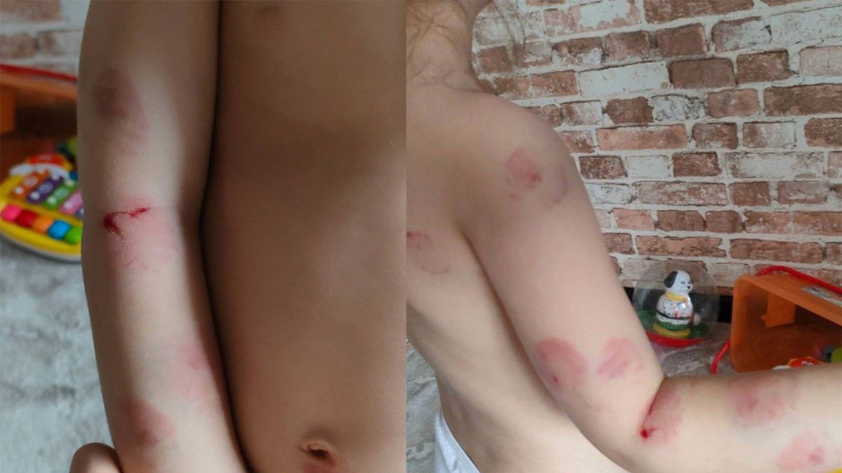 В омском садике 3-летнюю малышку зверски покусала сверстница