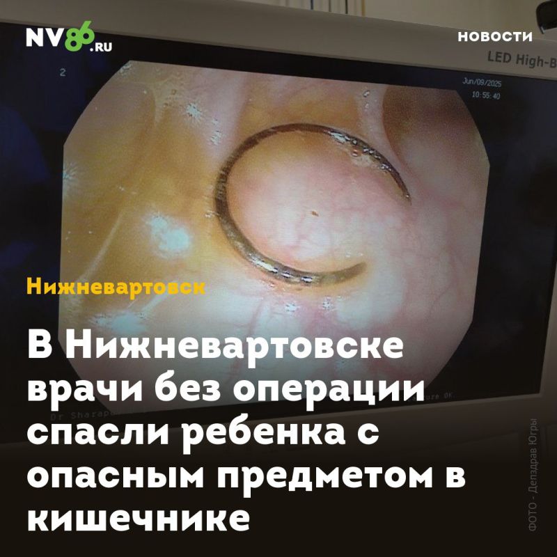 В Нижневартовске врачи без операции спасли ребенка с опасным предметом в кишечнике
