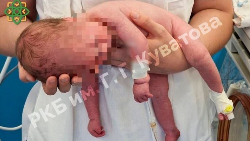 В Уфе врачи спасли малыша с синдромом Прадера-Вилли