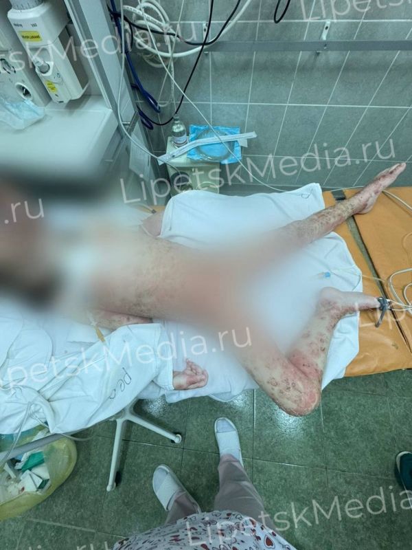 Борщевиком сожгла себе всё тело маленькая девочка