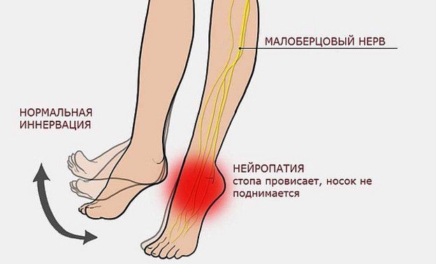 Детский невролог предупредила: поза «нога на ногу» может привести к параличу стопы