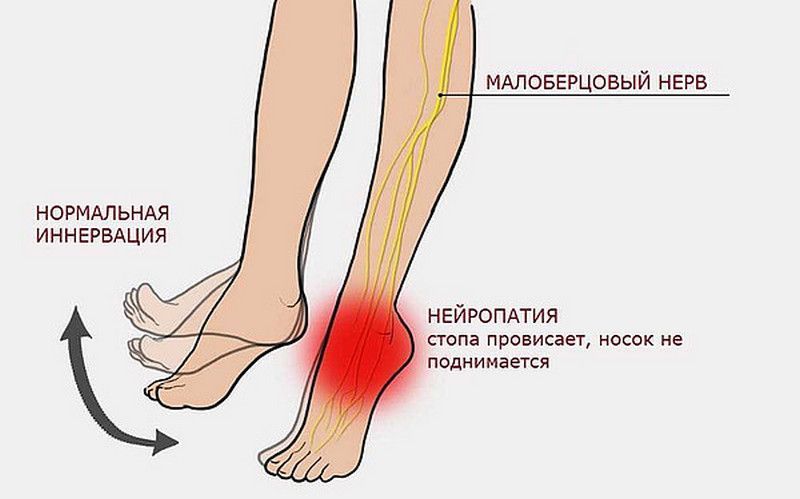 Врачи Кировской областной детской больницы восстановили подвижность ноги 13-летней девочки » ГТРК Вятка - новости Кирова и Кировской области