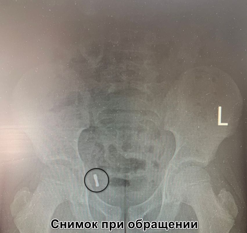Съеденные магнитики попали в аппендикс маленького воронежца