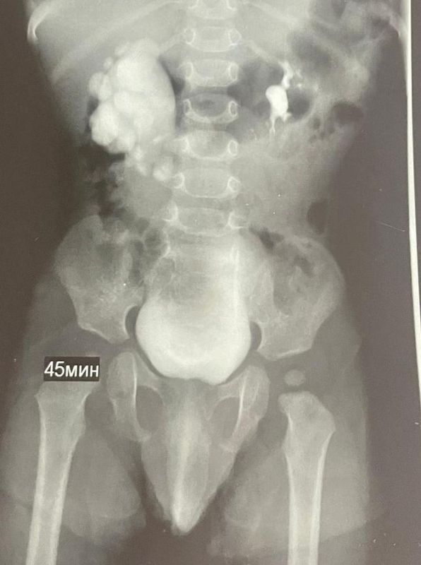 Ставропольские хирурги спасли ребёнку правую почку