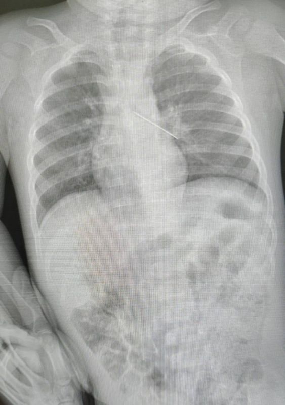 В Сургуте спасли ребёнка после того, как он проглотил английскую булавку