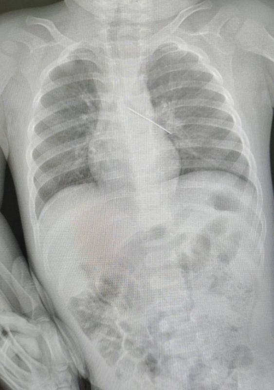 В Сургуте спасли малыша, проглотившего английскую булавку