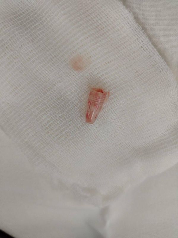 Калужские хирурги достали колпачок от ручки из бронхов школьницы