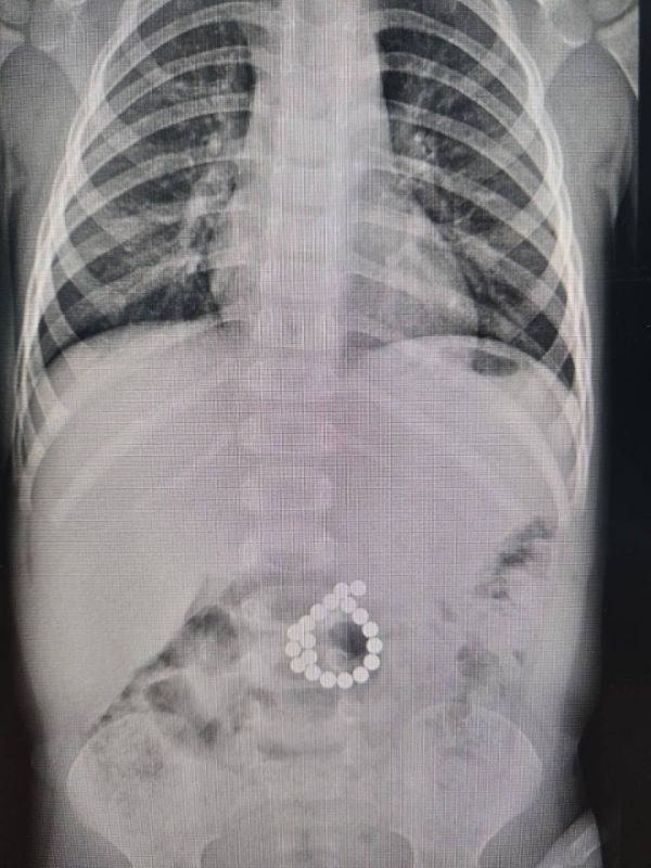 Сургутские врачи спасли малыша, который проглотил 19 магнитов