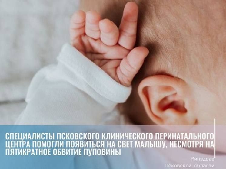 В Пскове врачи помогли родиться девочке с пятикратным обвитием пуповины
