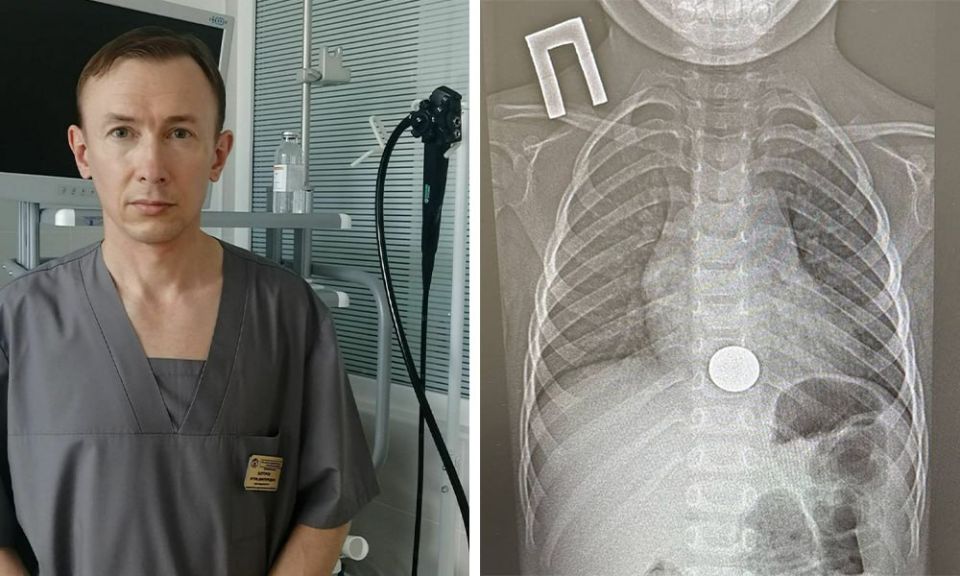 В Нижнекамске 3-летний ребёнок проглотил монету — врач вытащил её за минуту