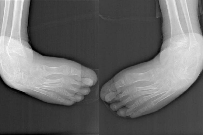 Иркутские врачи прооперировали 11-летнего мальчика с деформацией стоп