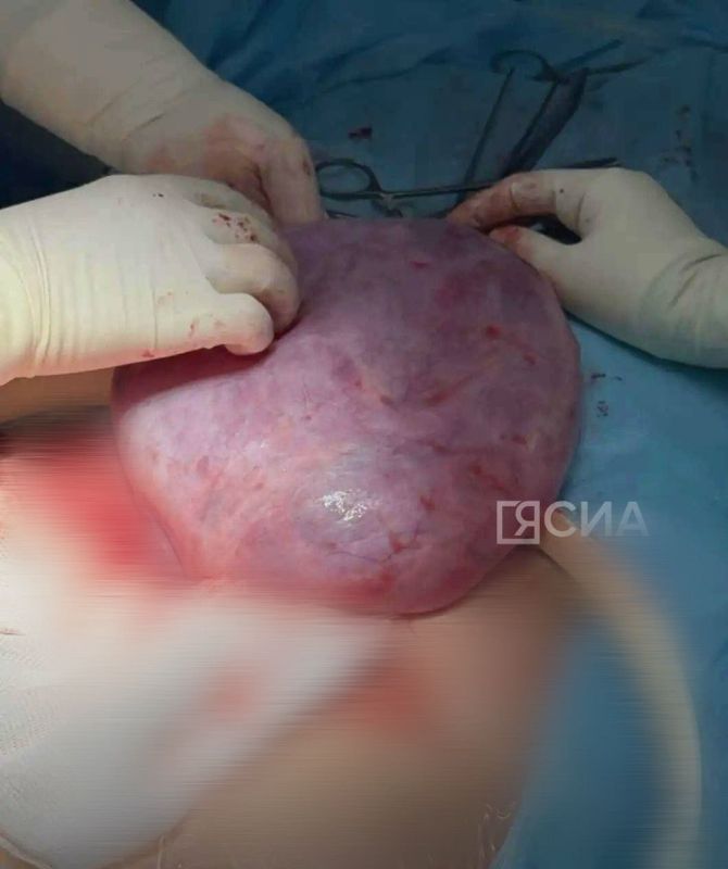 Якутские врачи спасли 30-летнюю женщину с гигантской кистой яичника