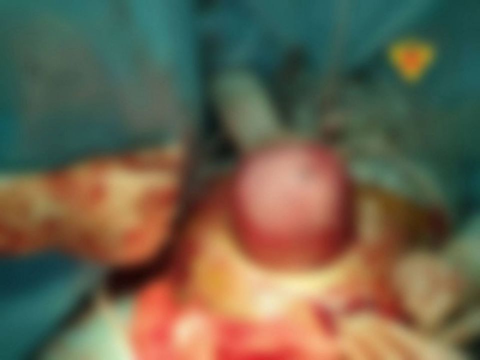 В Обнинске женщина смогла родить с 6-сантиметровой миомой