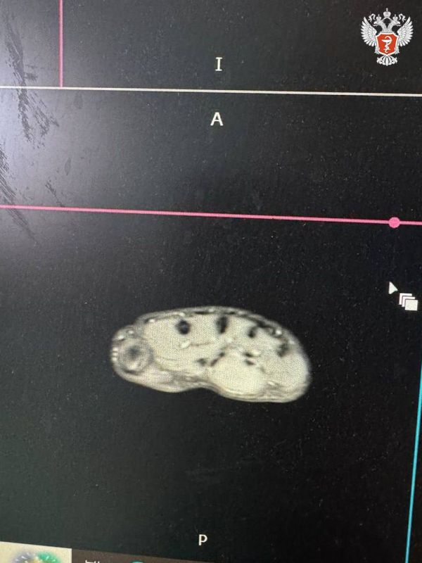 Липецкие врачи сохранили ребенку полноценную работу кисти после удаления опухоли