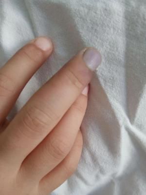 В Саратовской областной детской больнице спасли девочку с узелковым периартериитом