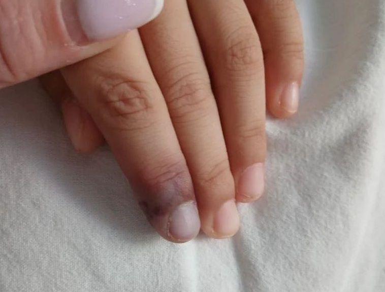 Саратовские врачи спасли девочку с редким аутоиммунным заболеванием