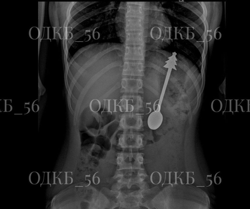 Проглотил ложку длиной 14 см: оренбургские врачи без разрезов спасли ребенка