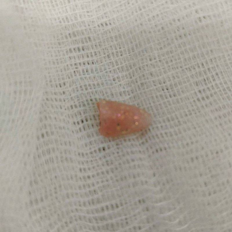 Накладной ноготь застрял в горле у 10-месячного малыша